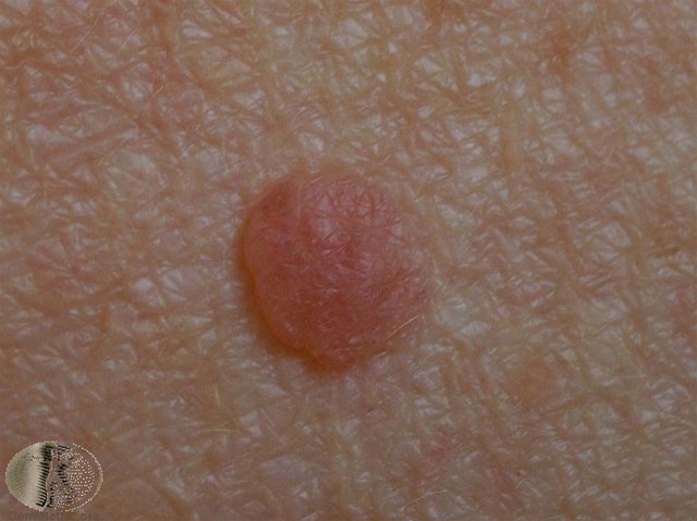 nevus dermal hos eldre