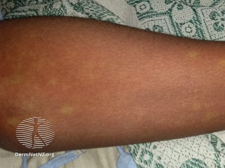 Dengue-rash