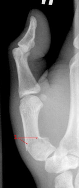 haand-metacarp-1-fraktur-roentgen