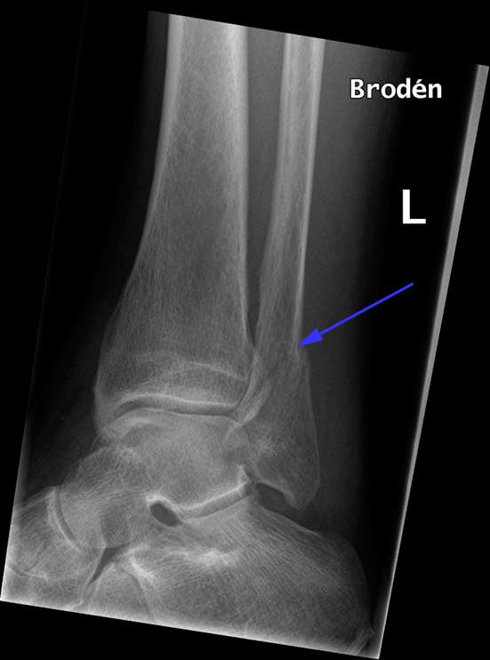 underben-fraktur af spolebenet