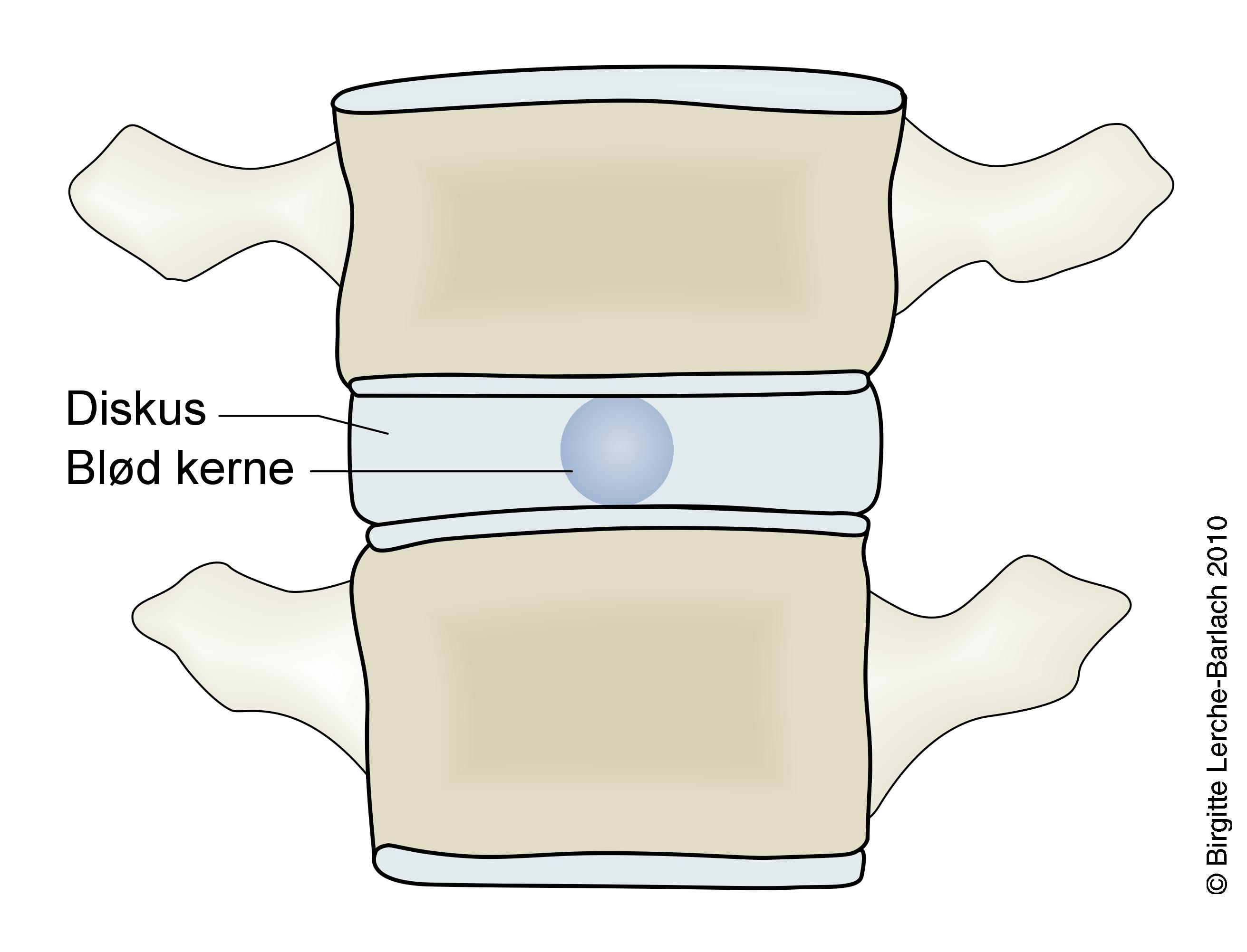 ryghvirvel-diskus uden kompression