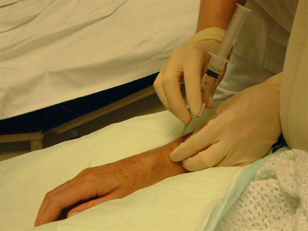 radius - fraktur - anaestesi