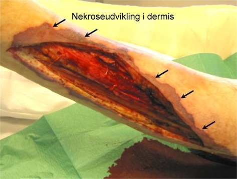 9082 2 nekroseudvikling i dermis jpg