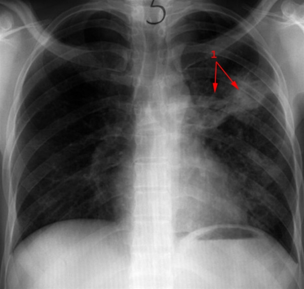 lunger-primaer tuberkulose-roentgen
