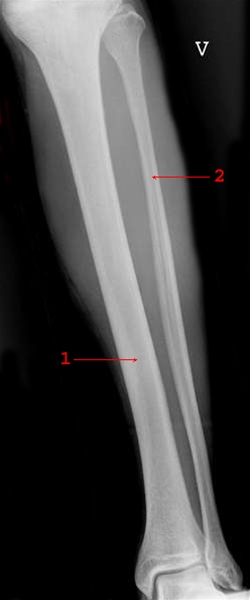 ben-ben front-roentgen