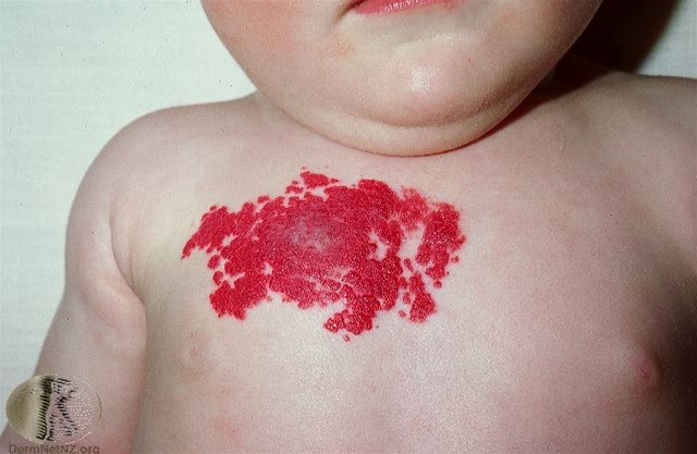 haemangiom proliferationssfasen2