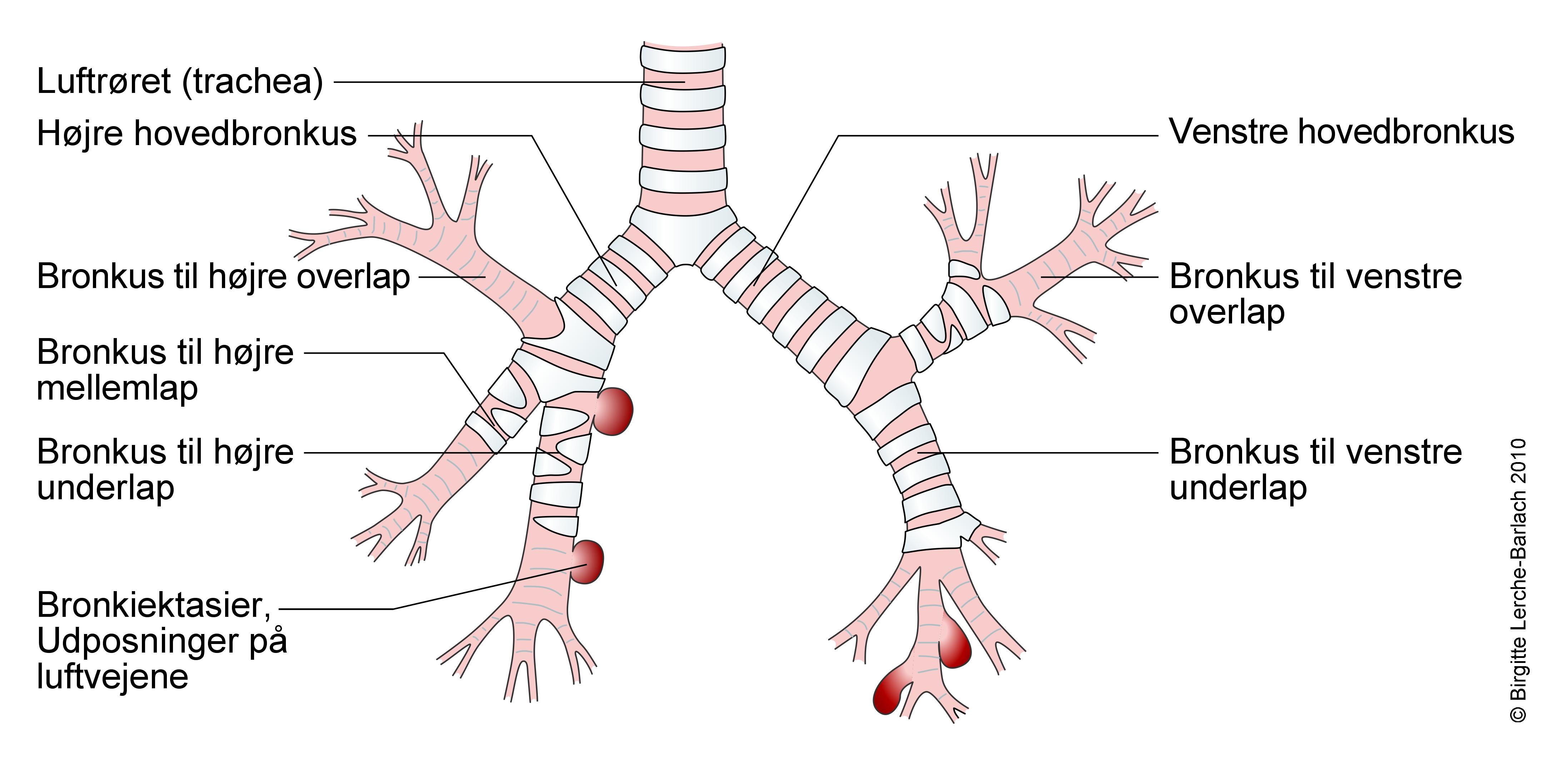 luftveje-bronkiektasier