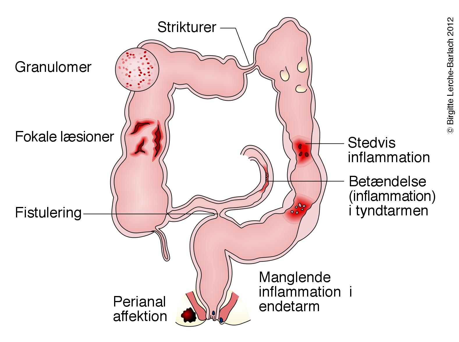 tarm-crohns sygdom-kendetegn