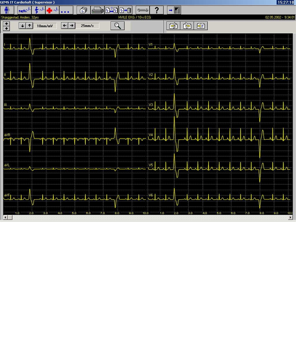 hjerte-ventrikulaere ekstrasystoler