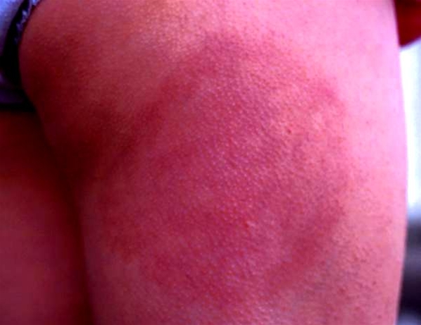 erythema migrans jpg