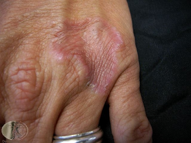 granuloma annulare lokalisert-fingre jpg