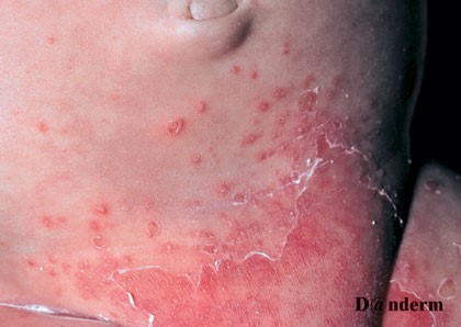 candida bledermatitis
