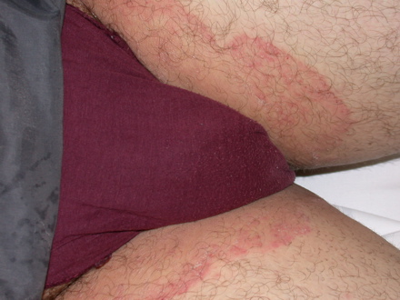 tinea cruris-lysken