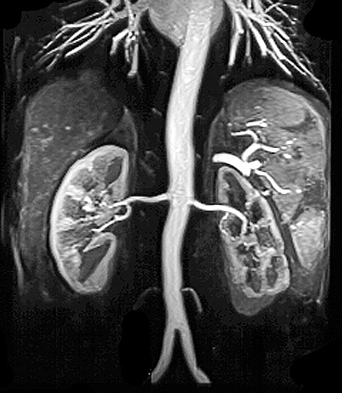 nyre-angiografi af normal aorta og nyrearterier-mr