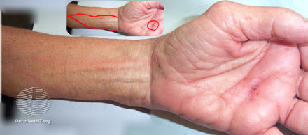Foto af lymfangitis på underarm