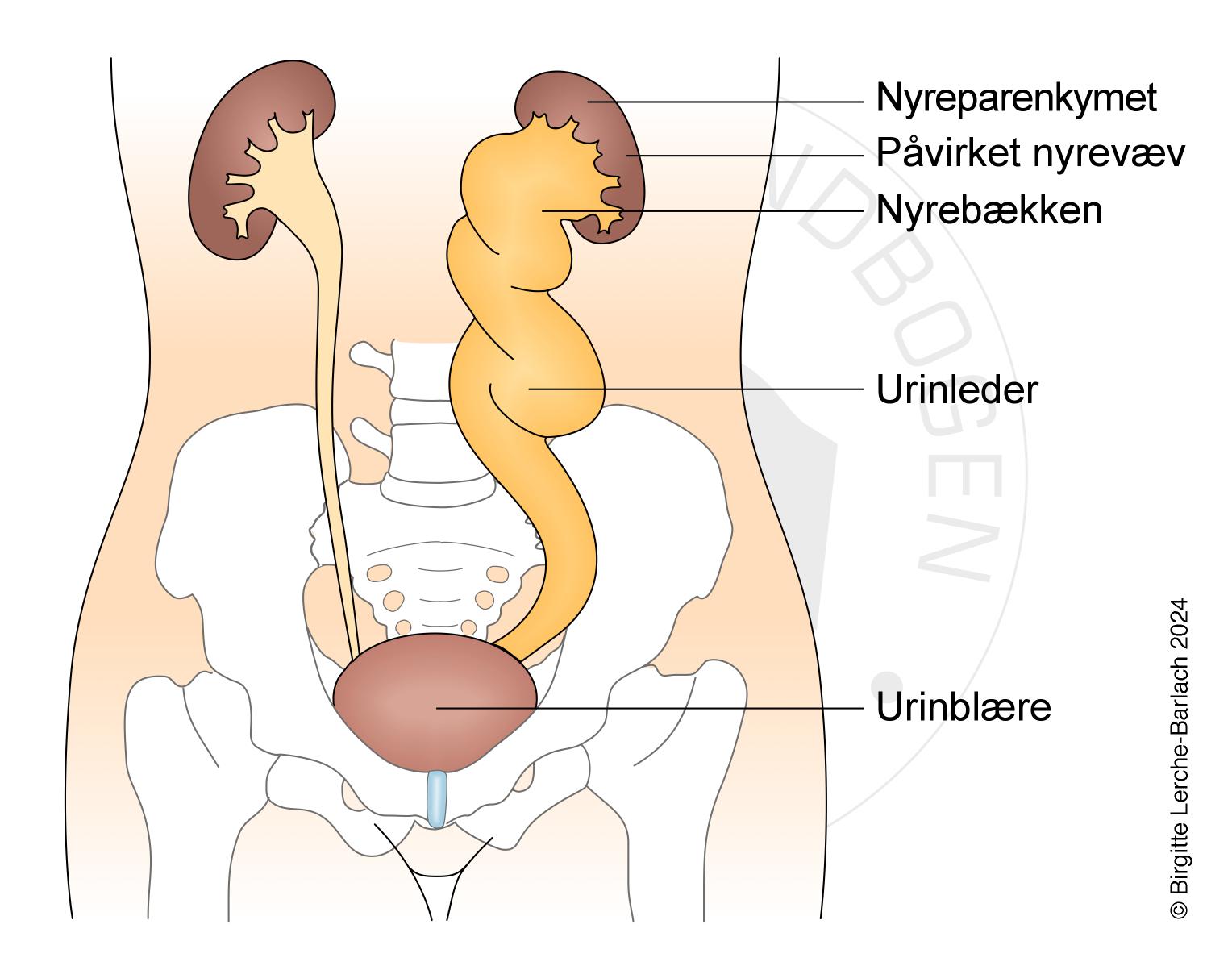 LH_512 Grad 5 refluks urin