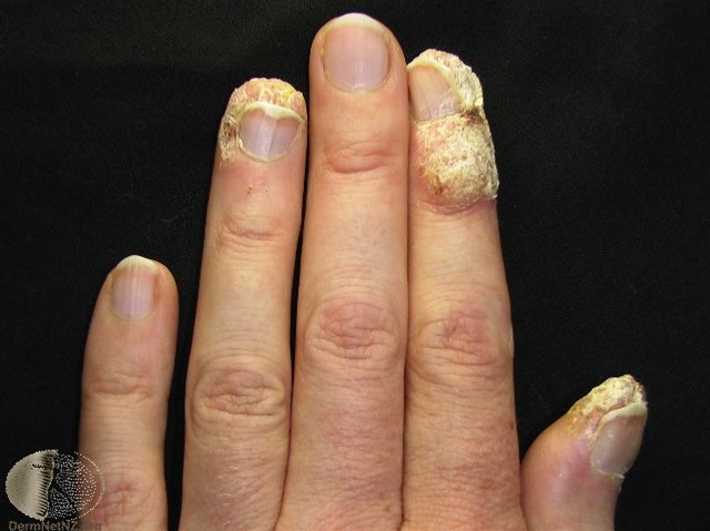 vorter periunguale-fingre