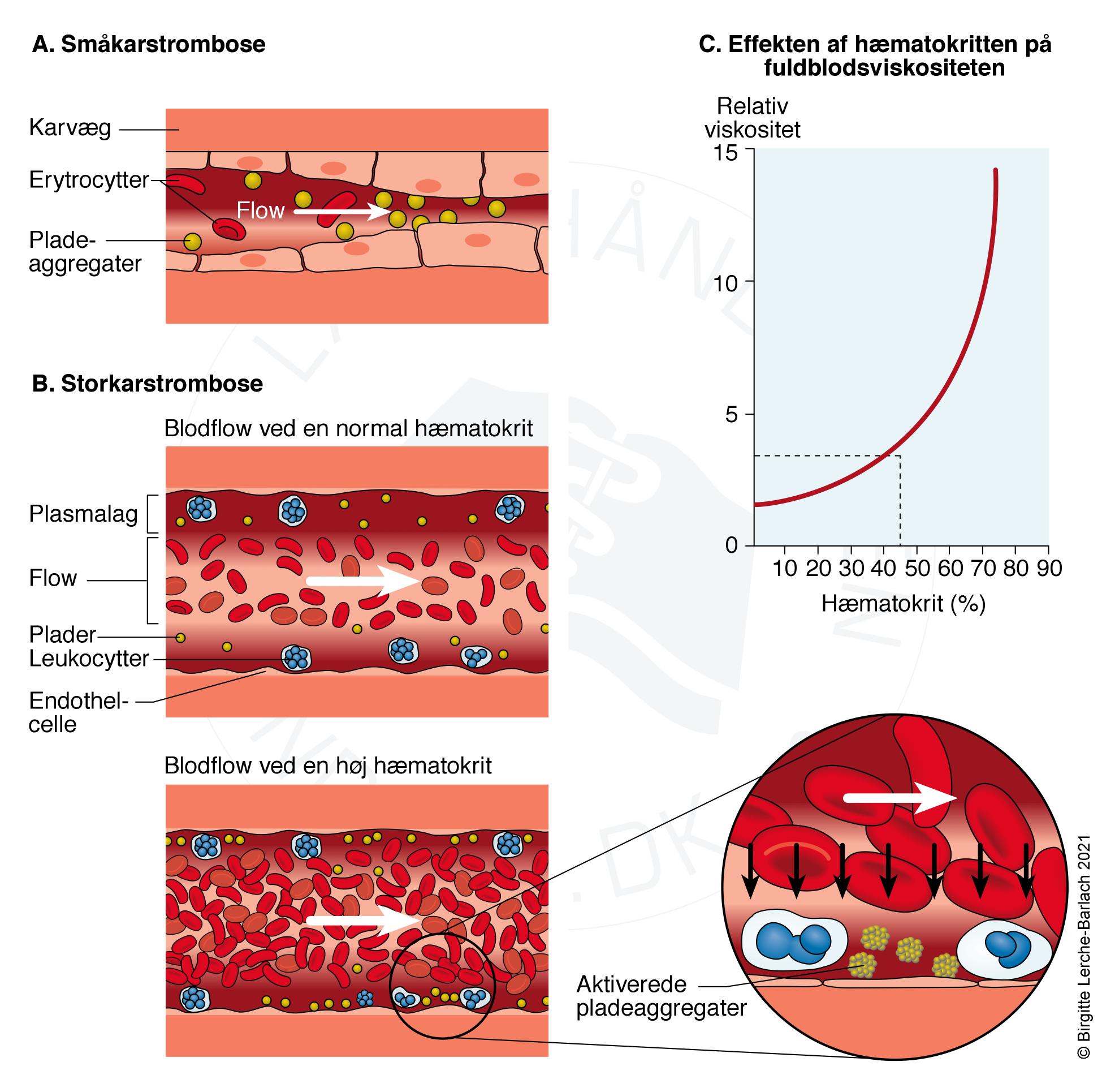 hyperviskositet med tykt blod