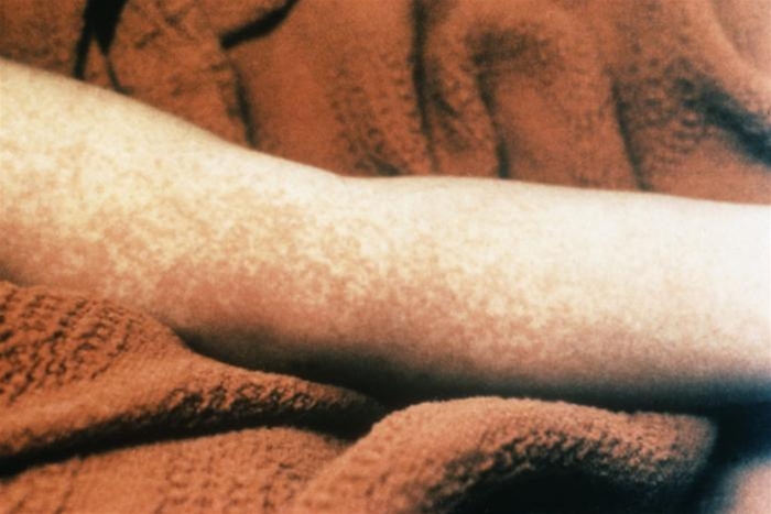 udslaet-toksisk shock