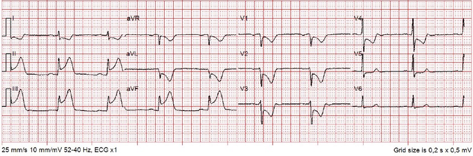 Inferiort infarkt akut