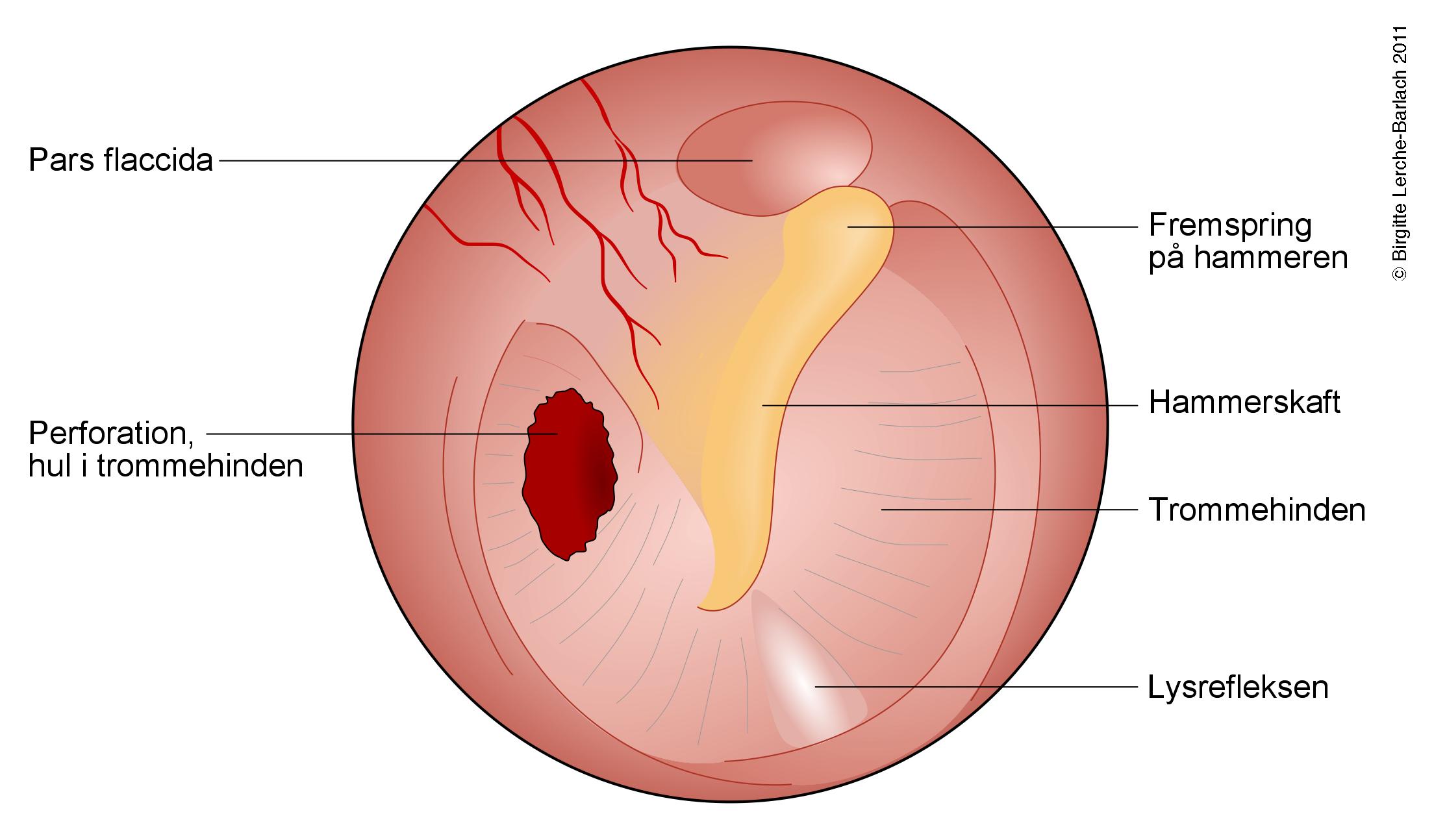oerer-trommehinde med perforation