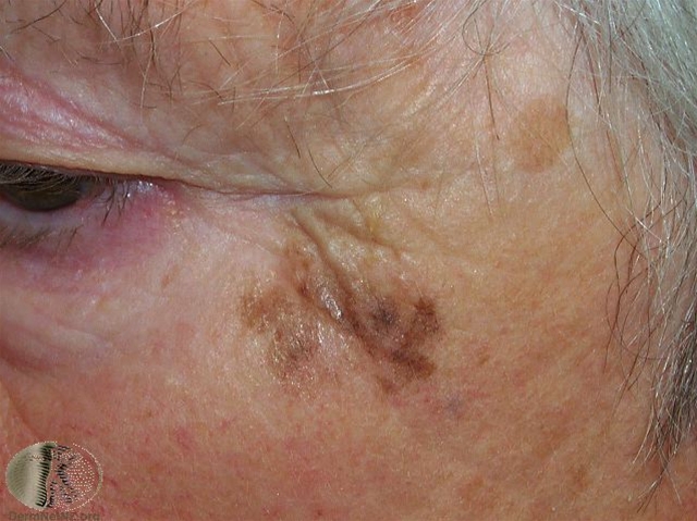 malignt melanom lentigo maligna