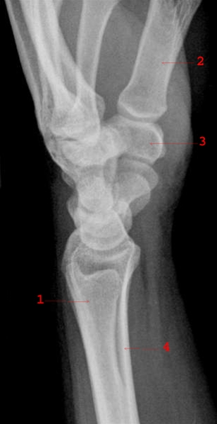haand-haandled set fra siden-roentgen