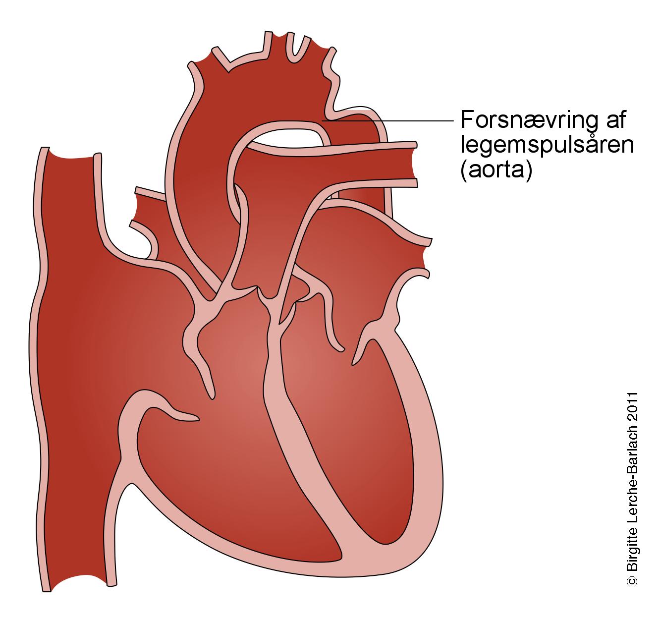 hjerte-forsnaevring af hovedpulsaaren