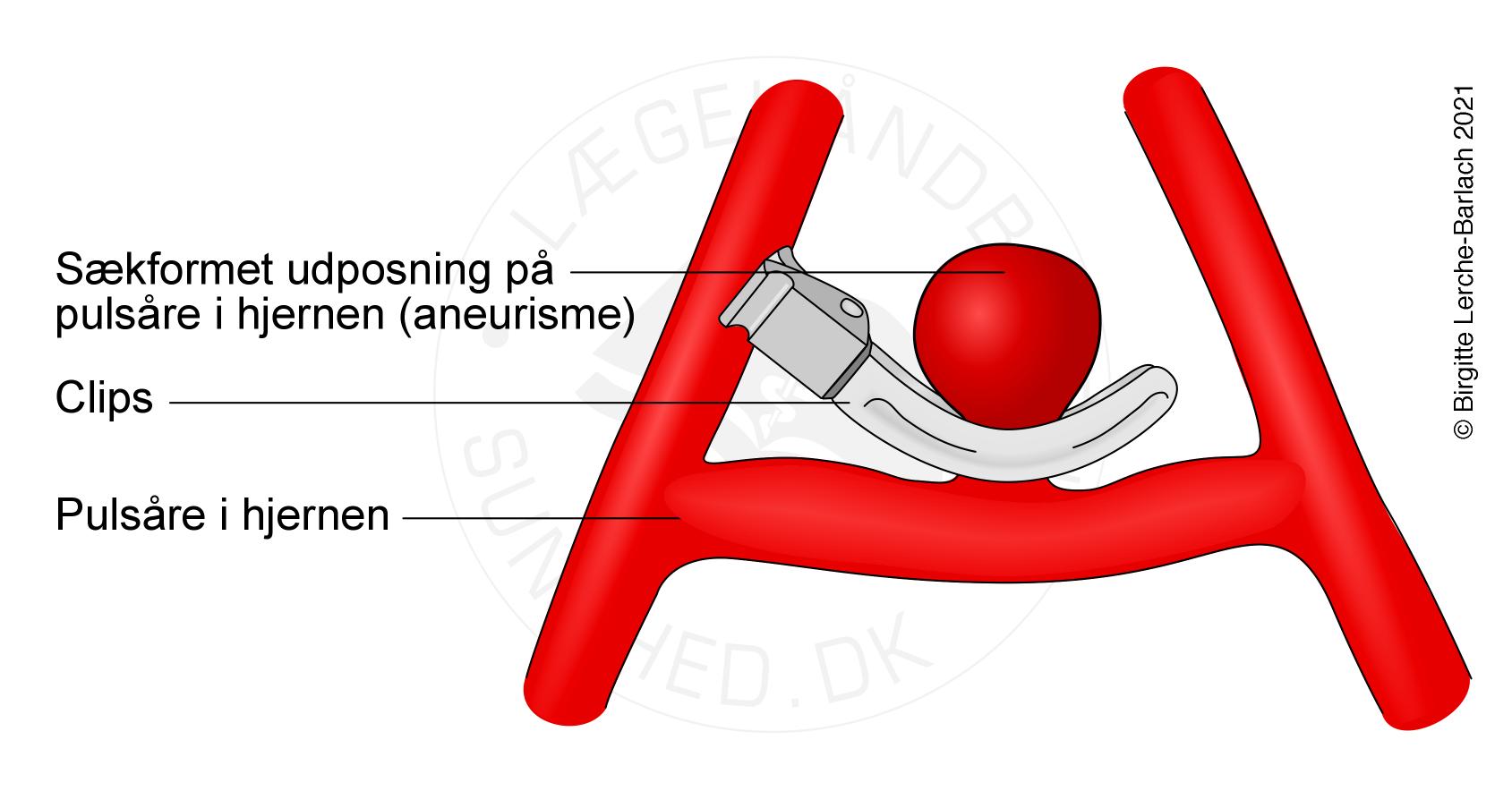 aarer-aneurisme klips