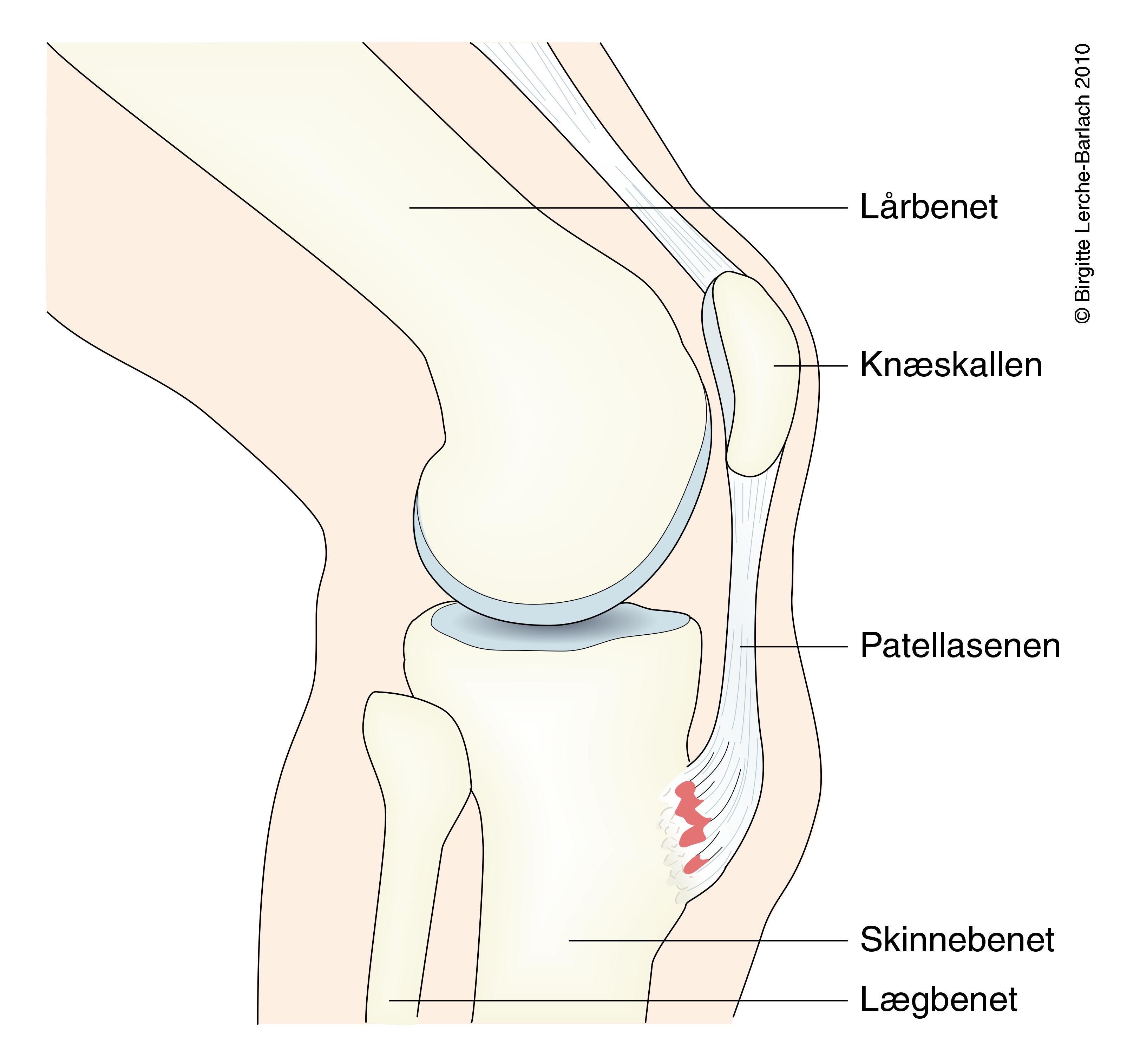 knae osgood schlatters sygdom