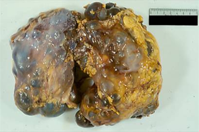 nyre-polycystisk-fjernet fra dialysepatient