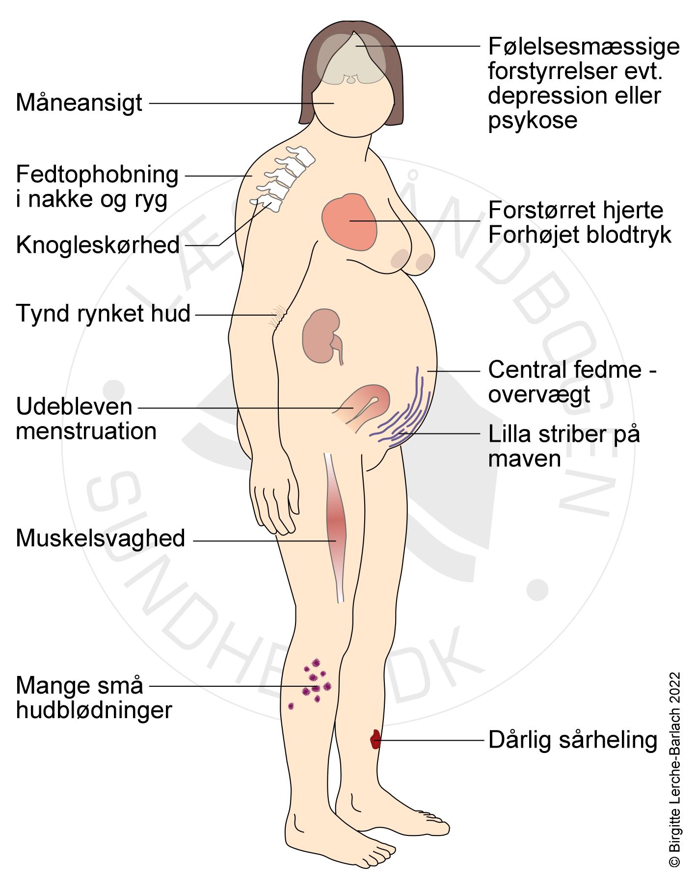 cushing syndrom symptomer