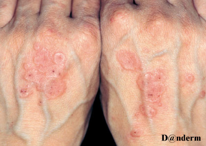 Erythema-multiforme