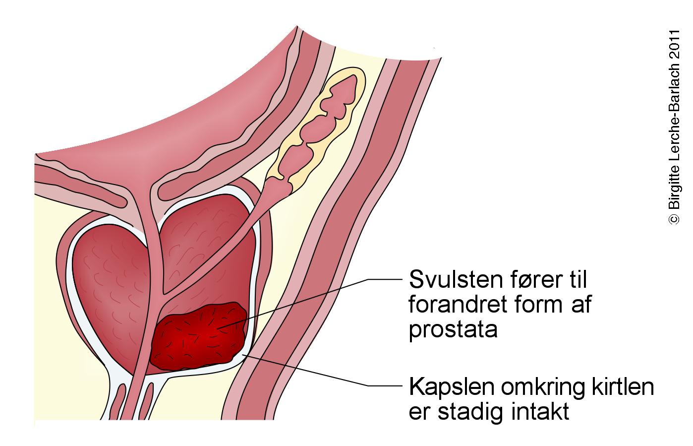 prostata-prostatacancer stadie 2