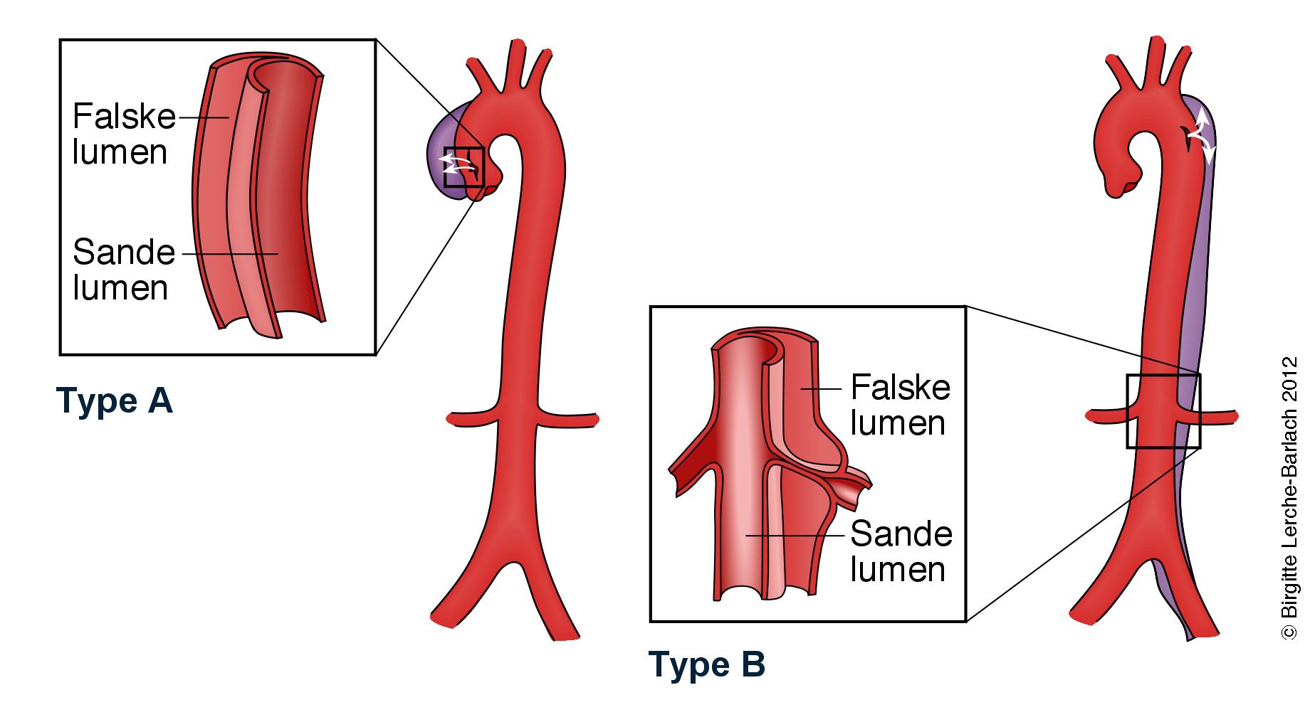 aarer-aorta dissektioner