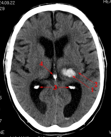 hjerne-cerebral bloedning thalamus-ct