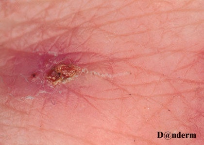 scabies - burrow and mite
