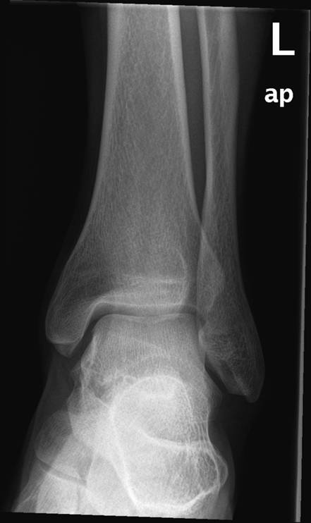 fod-normalt af venstre fodled i 2 projektioner1-roentgen