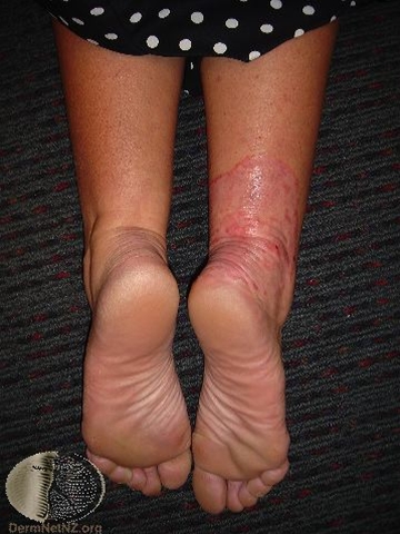 tinea corporis-1-ben