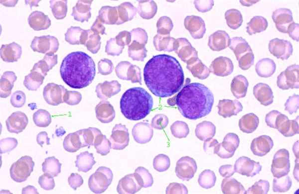 blod-akut myelogen leukaemi