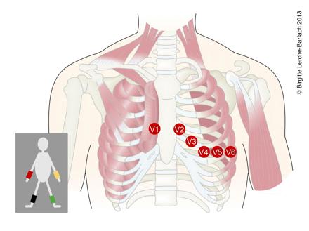 Tegning af placering af elektroder ved ekg 