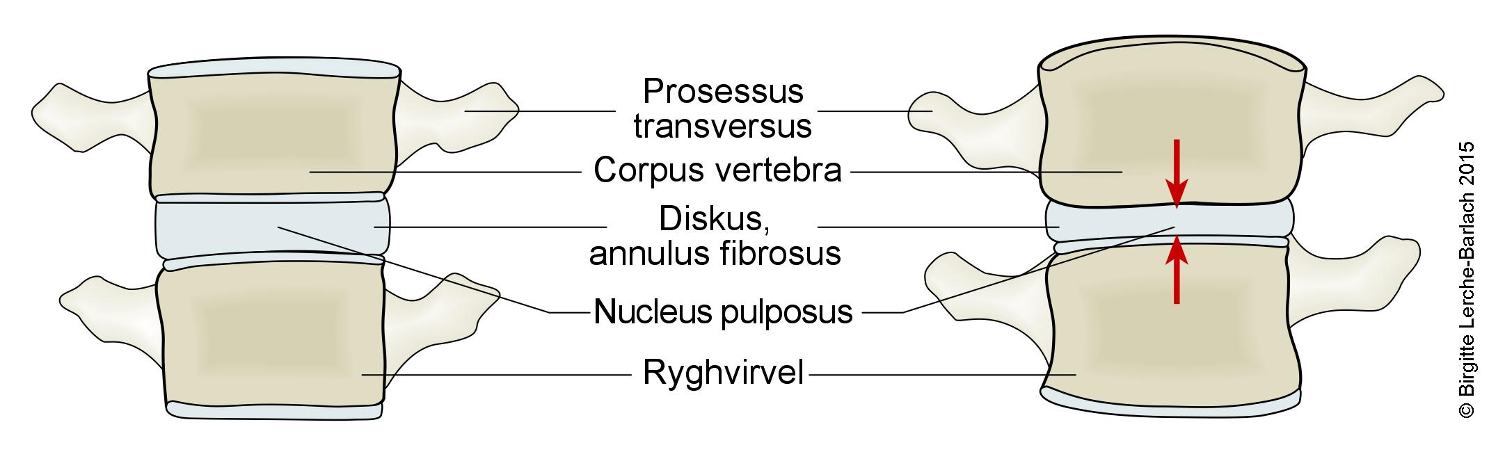 rygsoejle-diskus med og uden kompression