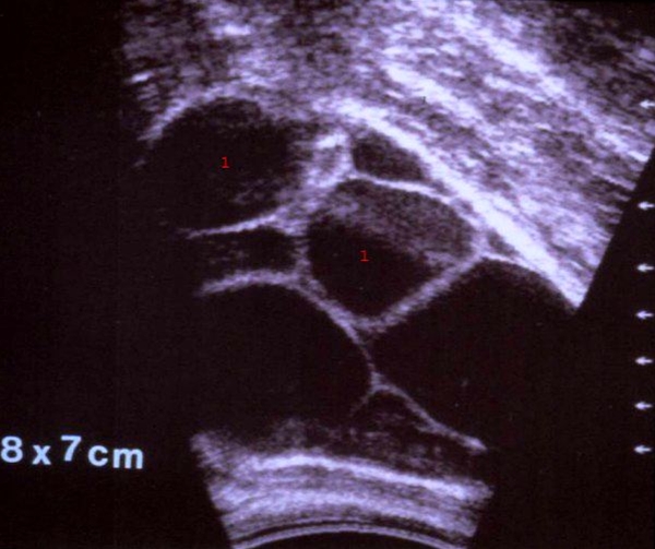 aeggestok-theca lutein cyster-ultralyd