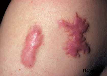 Keloid godartet arsvulst i huden