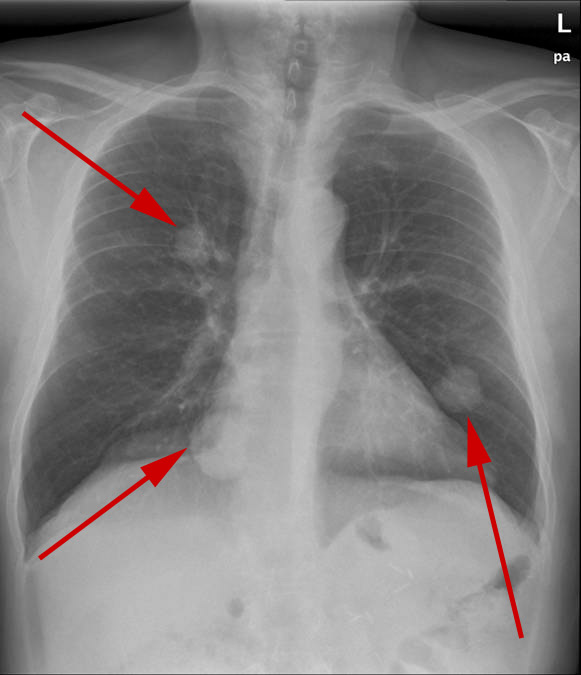 lunger-metastaser-rtg frontal