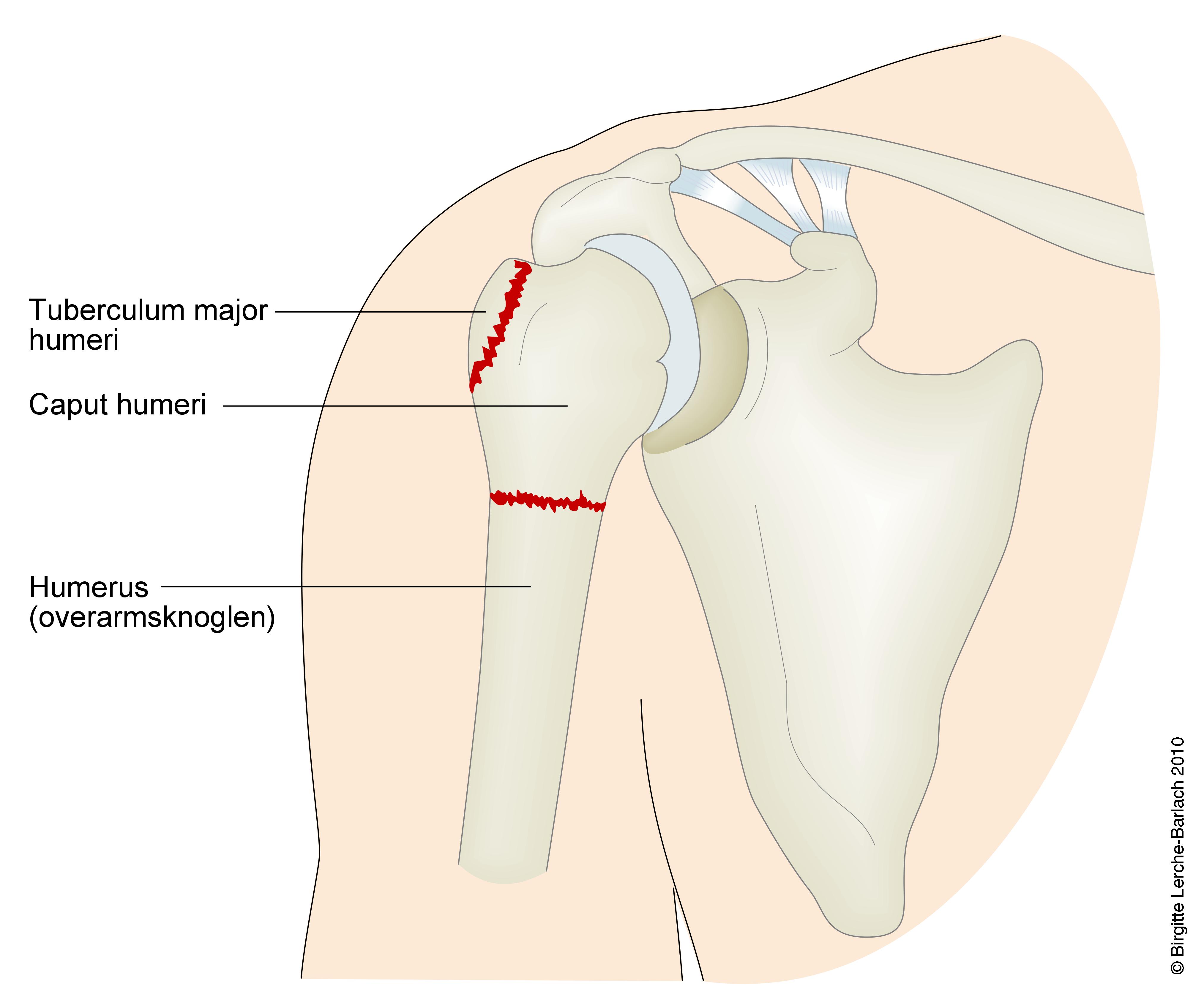 arm-fraktur humerus caput 7318