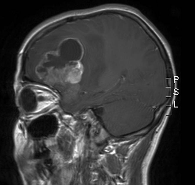hjerne-anaplastisk ependymom 1-mr