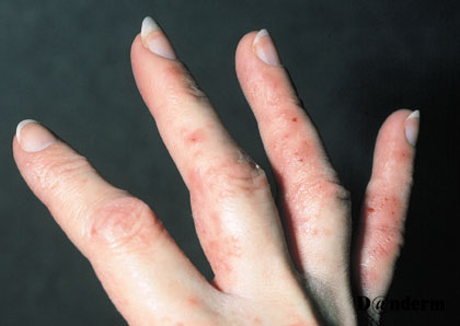 Recurrent vesicular dermatitis of the fingers