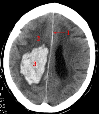 hjerne-cerebral bloedning-ct