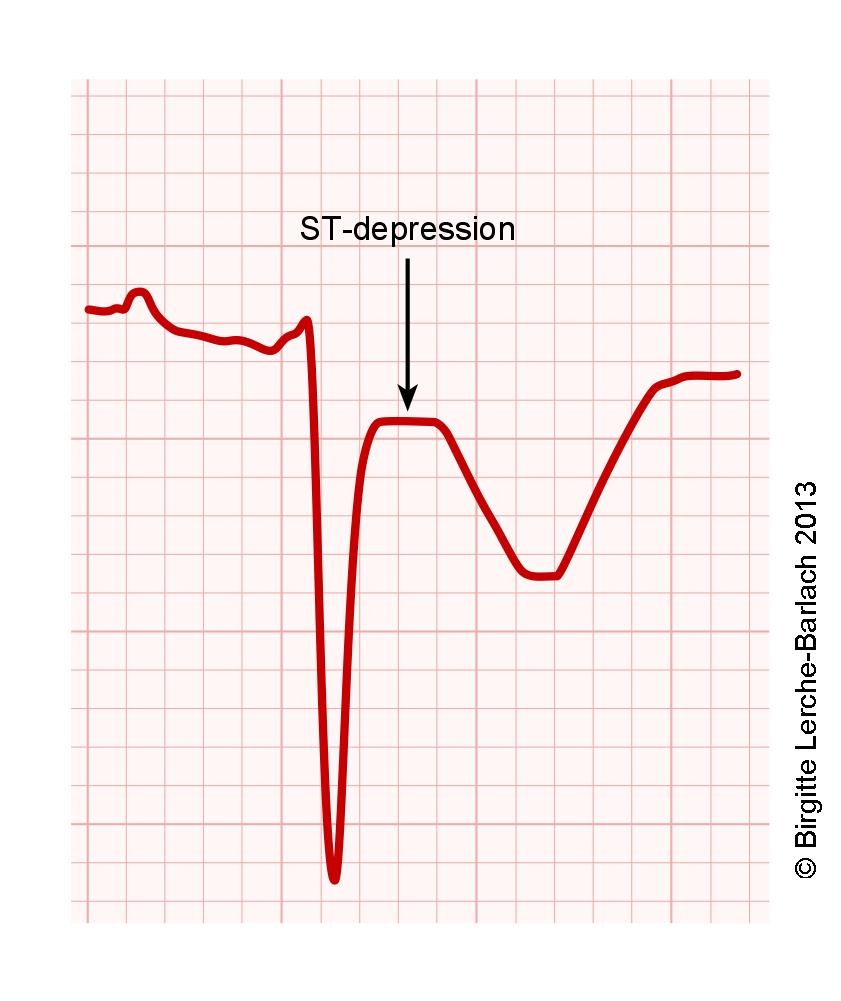 ST-depression